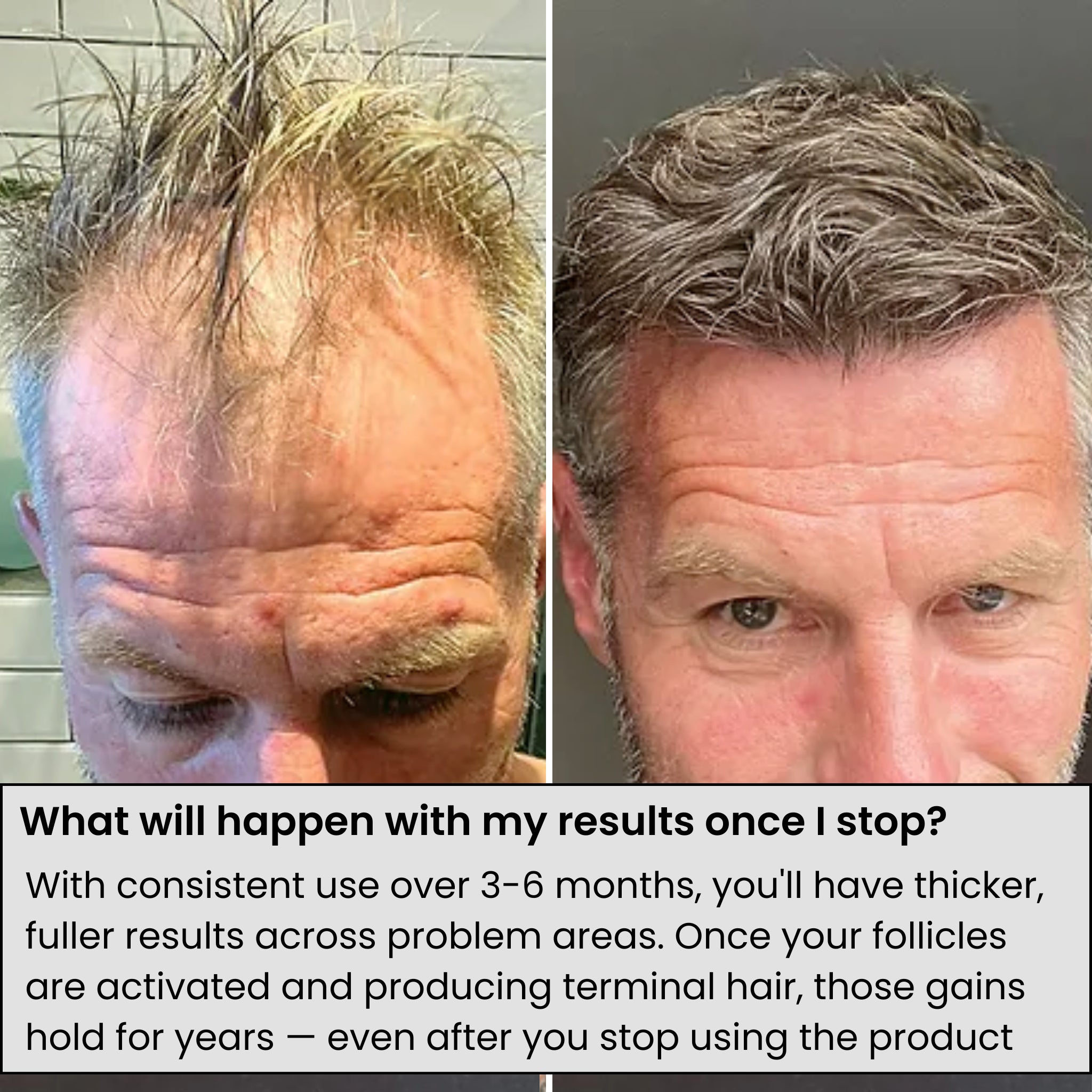 AlphaVance™ Hair Growth System
