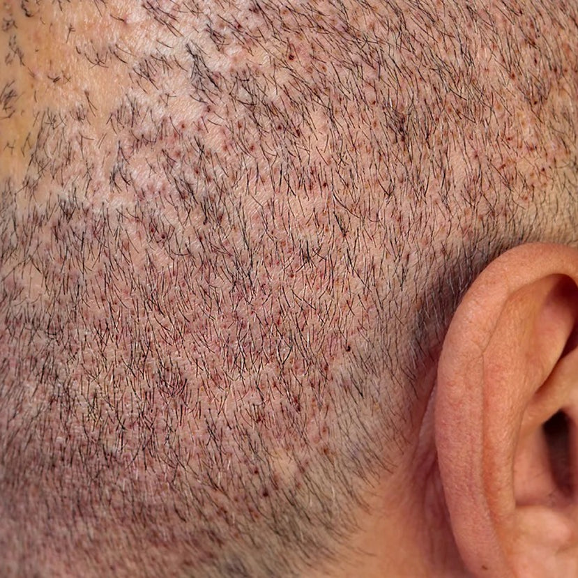 Close-up of a person's scalp with short hair and visible pores.