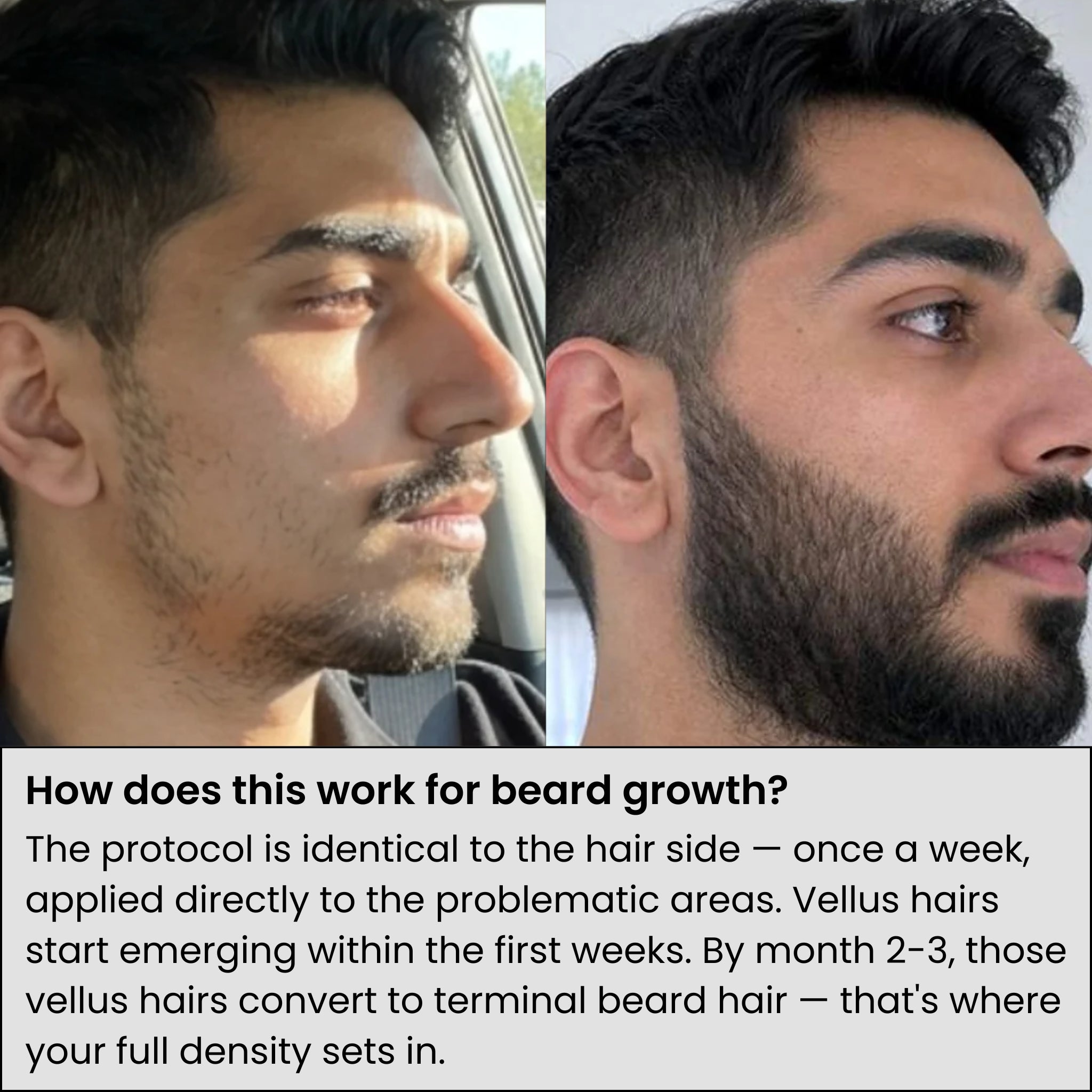 AlphaVance™ Hair Growth System