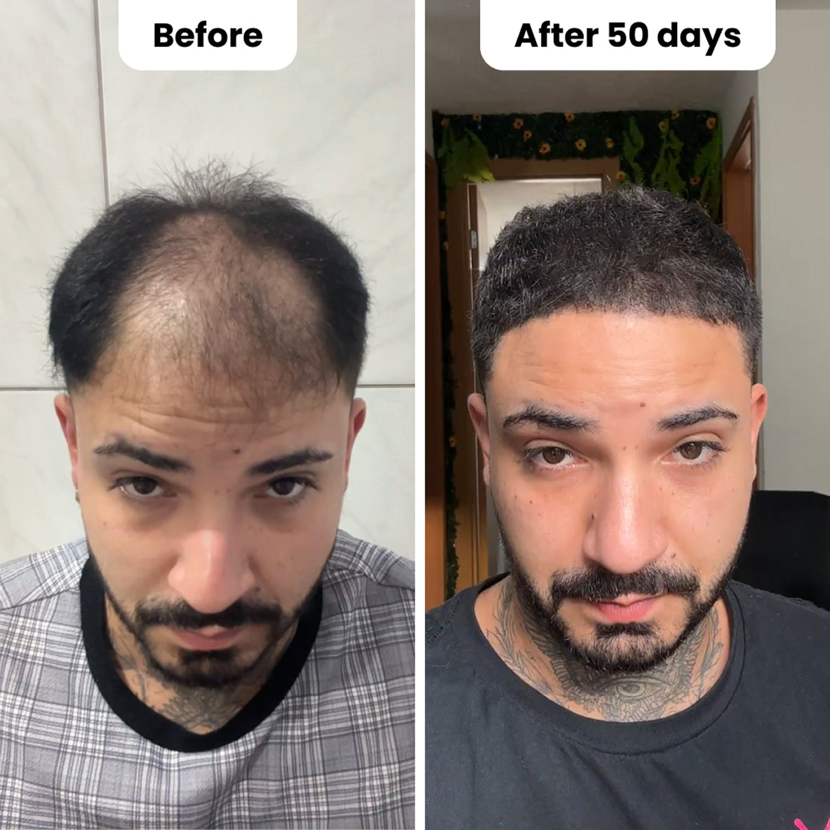 A man before and after hair regrowth over 50 days.