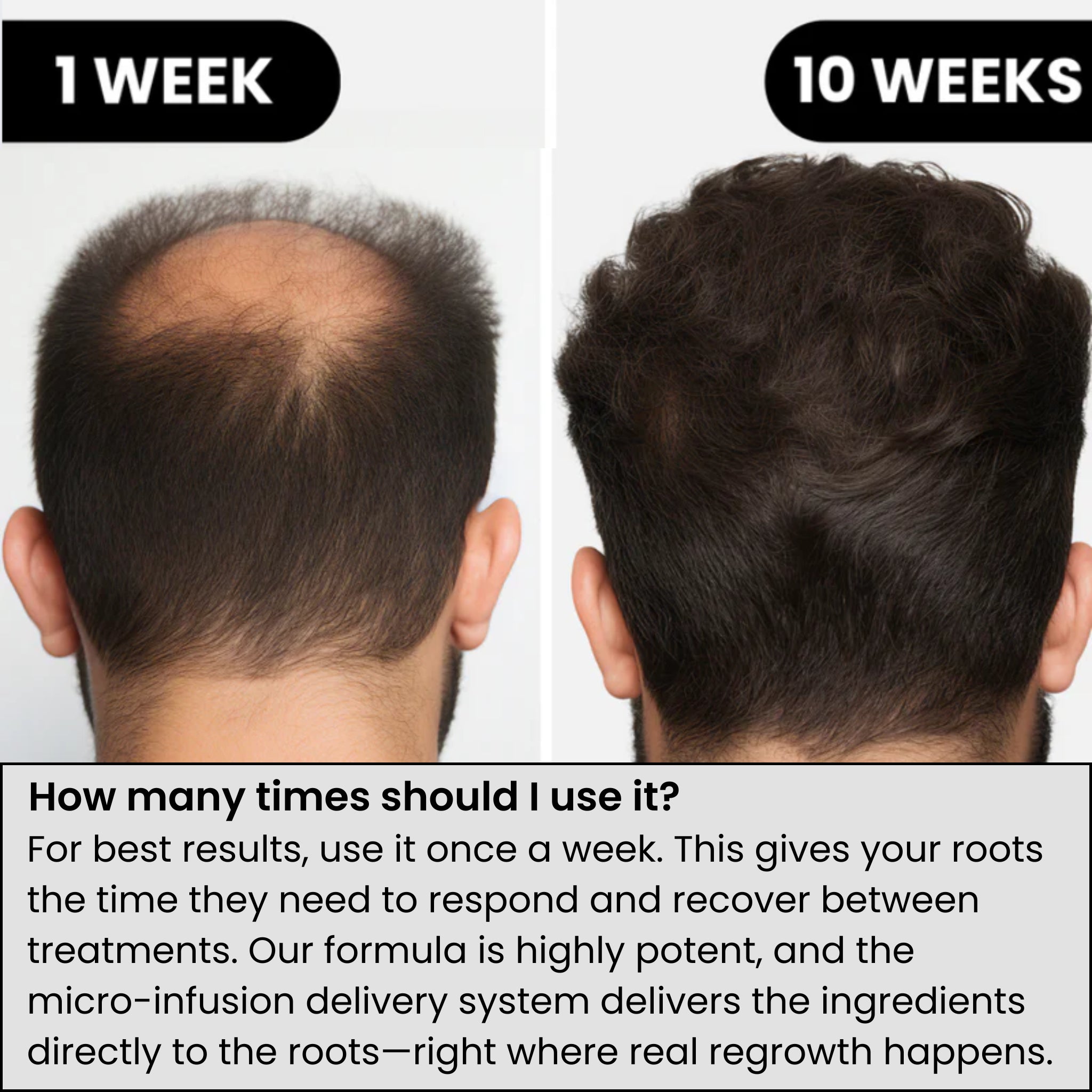 AlphaVance™ Hair Regrowth System