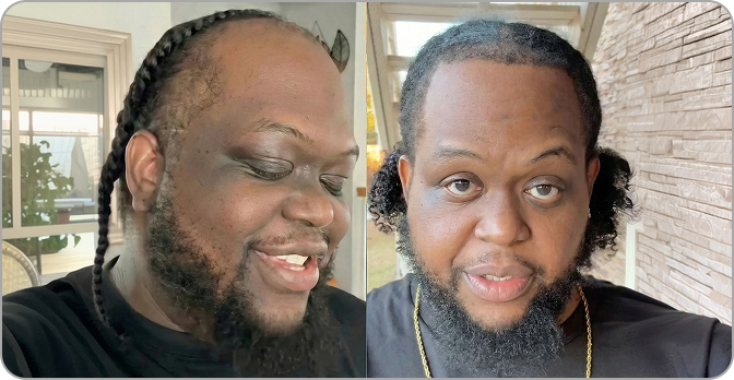 AlphaVance customer regrowth result