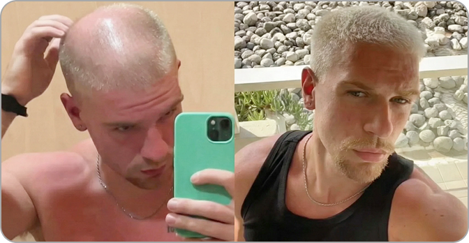AlphaVance customer hair regrowth result photo